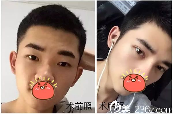 嘉兴曙光阿尔法美眼案例效果 嘉兴曙光阿尔法美眼案例效果