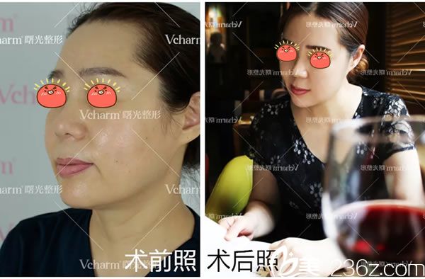 嘉兴曙光4D线雕提拉逆龄案例效果 嘉兴曙光4D线雕提拉逆龄案例效果