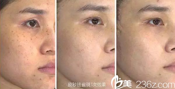 酒泉华美皮秒激光祛斑效果案例 酒泉华美皮秒激光祛斑效果案例