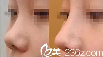 韩式SUS隆鼻案例