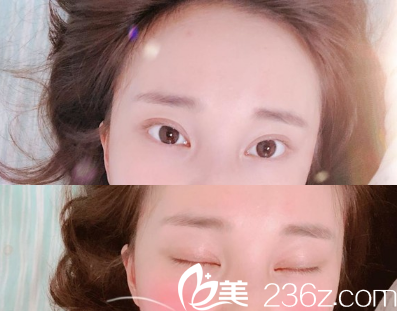 双眼皮术后4个月,睁眼有神闭眼无痕 双眼皮术后4个月,睁眼有神闭眼无痕