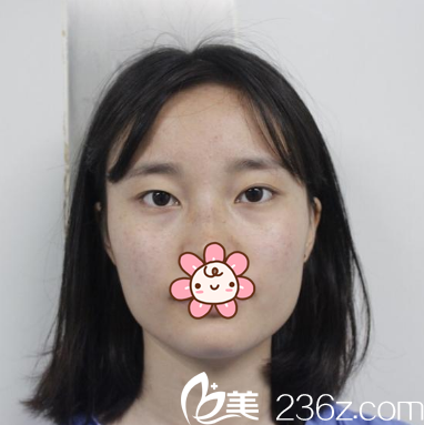 单眼皮的我马上要在成都艾米丽蜕变了 单眼皮的我马上要在成都艾米丽蜕变了