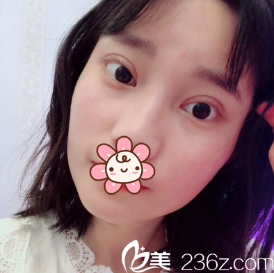 程红涛切开双眼皮术后11天效果 程红涛切开双眼皮术后11天效果