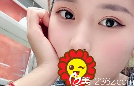 晒一下​酒泉华美整形杨艳给我割双眼皮1-7天的恢复图 开眼角也一起做了