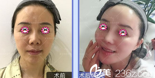 北京新美荟整形医院黄晓哲院长自体脂肪面部填充鼻修复案例