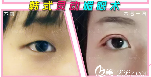 周创业双眼皮案例