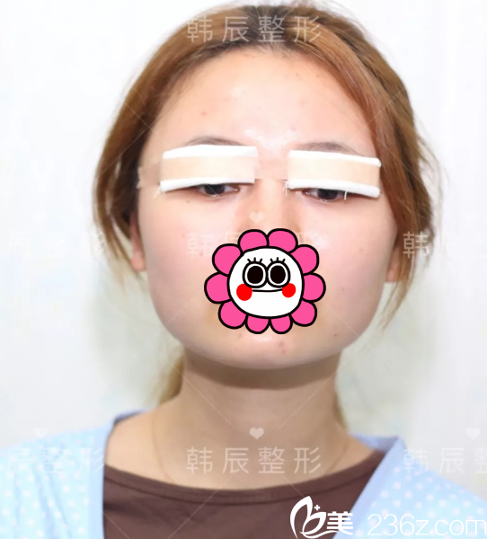 刚做完眼综合整形手术