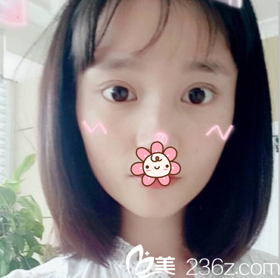 切开双眼皮术后一个月恢复照片 切开双眼皮术后一个月恢复照片