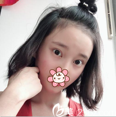 成都艾米丽切开双眼皮术后3个月效果 成都艾米丽切开双眼皮术后3个月效果