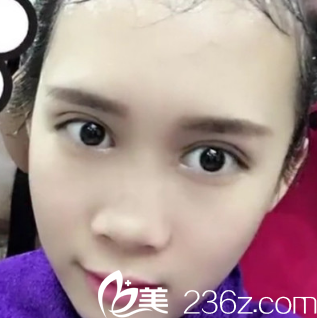 这是术前我的鼻子和短下巴 这是术前我的鼻子和短下巴