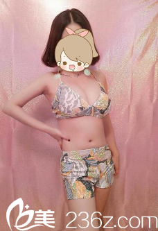 贵阳华美黄皓假体丰胸术后三个月效果 贵阳华美黄皓假体丰胸术后三个月效果