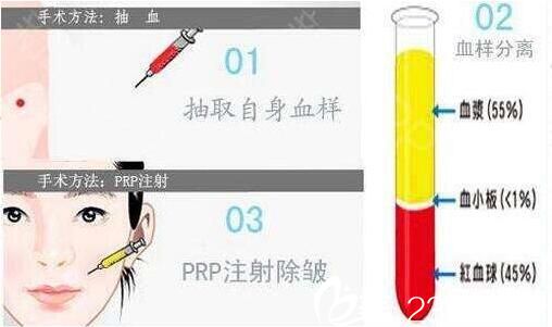  PRP自体血清注射除皱的四大原理