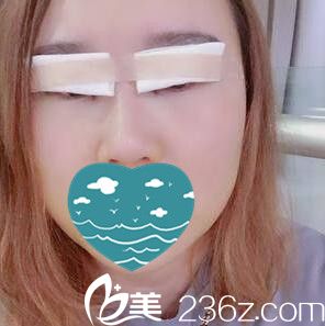 双眼皮+开眼角术后即刻效果