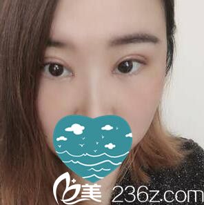 做双眼皮+开眼角术后一周拆线