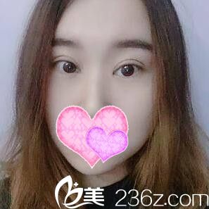 在丹东做双眼皮+开眼角术后半个月情况