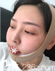 第二天脸肿了 第二天脸肿了