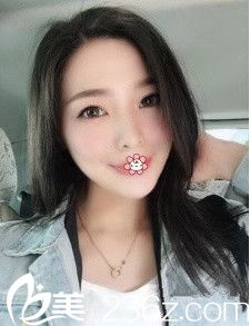 钱刚面部吸脂术后一个月 钱刚面部吸脂术后一个月