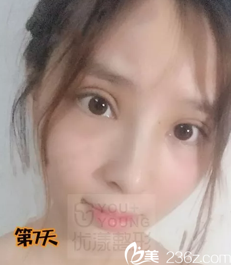 下定决心到哈尔滨优漾美容医院找方彬主任做了开扇型自然款双眼皮桃花