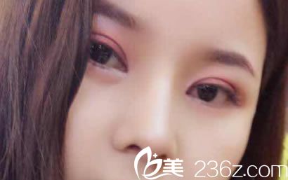 到杭州网红整形医院艺之花找段江华做了全切双眼皮和肋软骨网红鼻综合隆鼻手术