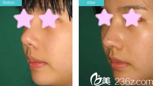 太原欧美莲整形雷雪华鼻综合案例效果图