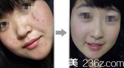 <!--<i data=20240703-sp></li>
                        </a>
                       </ul>
                    </div>
                                        <p>女孩子们总想要面容精致,皮肤能够持久光滑靓丽,所以脸上的痤疮痘痘什么的就很惹人嫌弃了,其实做激光美肤就行,整形激光祛痘去痘印很专业!激光祛痘的原理:激光能穿透至青</p>
                        <div class=