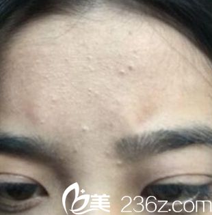 额头的痘痘 额头的痘痘