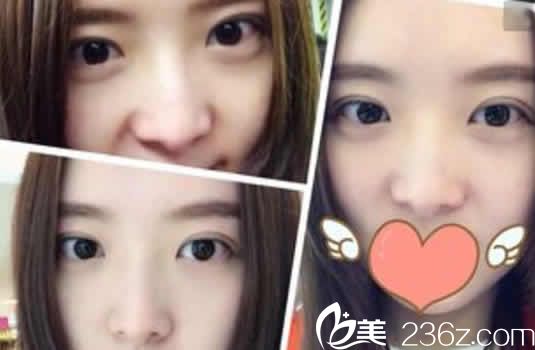 太原欧美莲姚冰双眼皮案例效果图