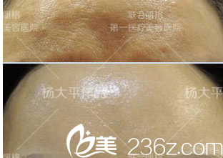 北京联合丽格杨大平童颜针取出脂肪修复案例