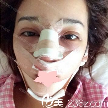 找合肥韩美整形闫品行做隆鼻失败修复及割双眼皮第2天样子 找合肥韩美整形闫品行做隆鼻失败修复及割双眼皮第2天样子