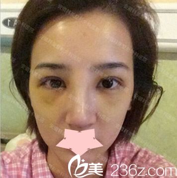 安徽韩美整形注射物取出+隆鼻失败修复第7天拆线图 安徽韩美整形注射物取出+隆鼻失败修复第7天拆线图