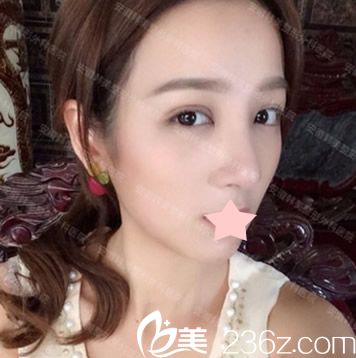 在合肥韩美做隆鼻失败修复+全切双眼皮术后第20效果图一览 在合肥韩美做隆鼻失败修复+全切双眼皮术后第20效果图一览