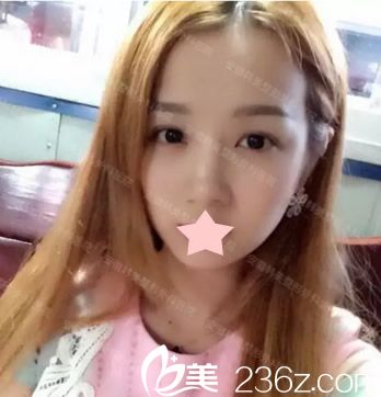 被注射假玻尿酸鼻子变宽照片 被注射假玻尿酸鼻子变宽照片