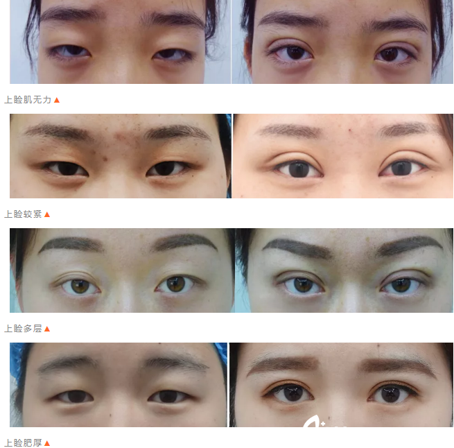 刘非医生双眼皮手术案例 刘非医生双眼皮手术案例