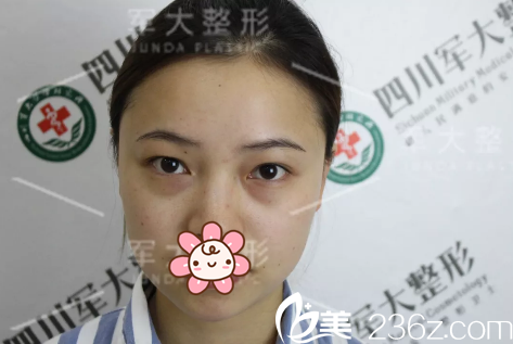 成都军大整形外科医院文科术前照片1