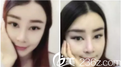 术后120天