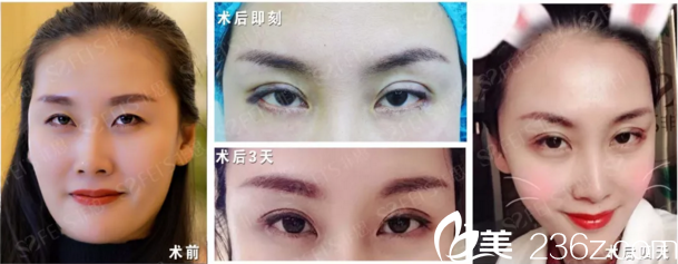 非思运营助理田欣灵埋线双眼皮+开后眼角 非思运营助理田欣灵埋线双眼皮+开后眼角