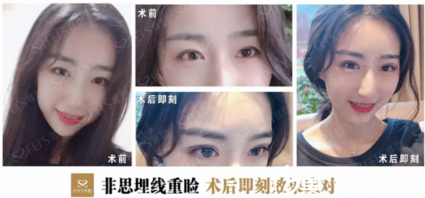 非思前台代妍埋线双眼皮效果 非思前台代妍埋线双眼皮效果