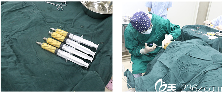 自体脂肪填充全脸手术中