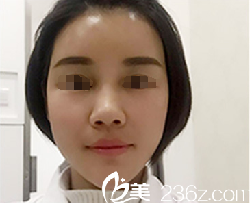 做完脂肪填充术后三天恢复