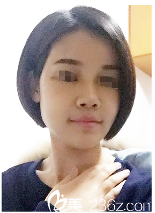 术后十天自体脂肪填充恢复中