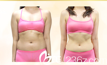 院长做吸脂手术