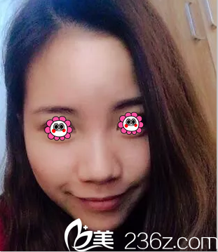 在北京樱桃做隆鼻前样子 在北京樱桃做隆鼻前样子