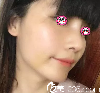 在北京樱桃做肋软骨鼻综合第17天 在北京樱桃做肋软骨鼻综合第17天