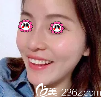 北京樱桃肋软骨鼻综合隆鼻 北京樱桃肋软骨鼻综合隆鼻