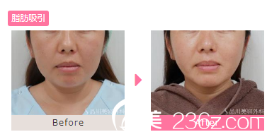 20181101_1541039965472798.png 脸部吸脂.png