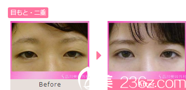 板井 双眼皮 板井 双眼皮