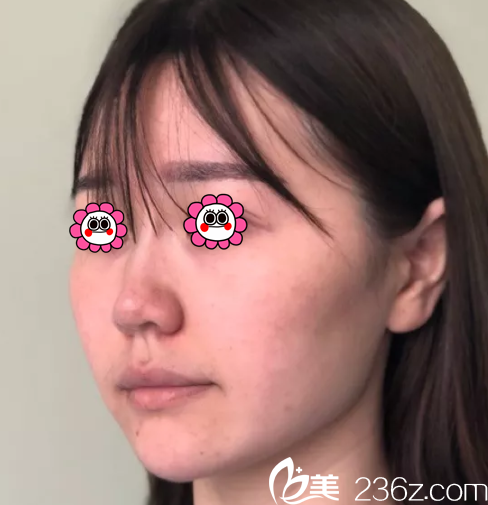 在北京樱桃做面部埋线提升之前样子 在北京樱桃做面部埋线提升之前样子