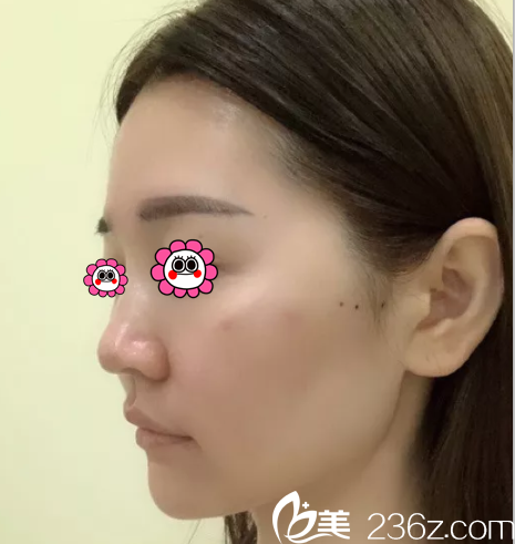 在北京樱桃做面部埋线提升第27天 在北京樱桃做面部埋线提升第27天