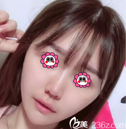 北京樱桃面部埋线提升 北京樱桃面部埋线提升