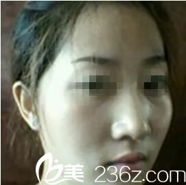 术前照片 术前照片